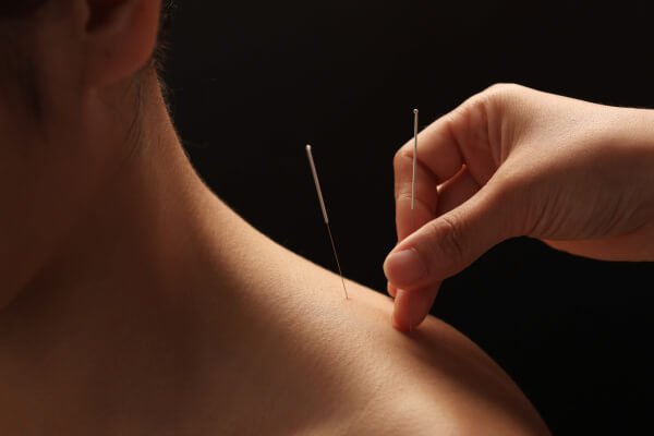 Gentle acupuncture on the shoulder for pain relief at The Gentle Needle Guy clinic in Brisbane