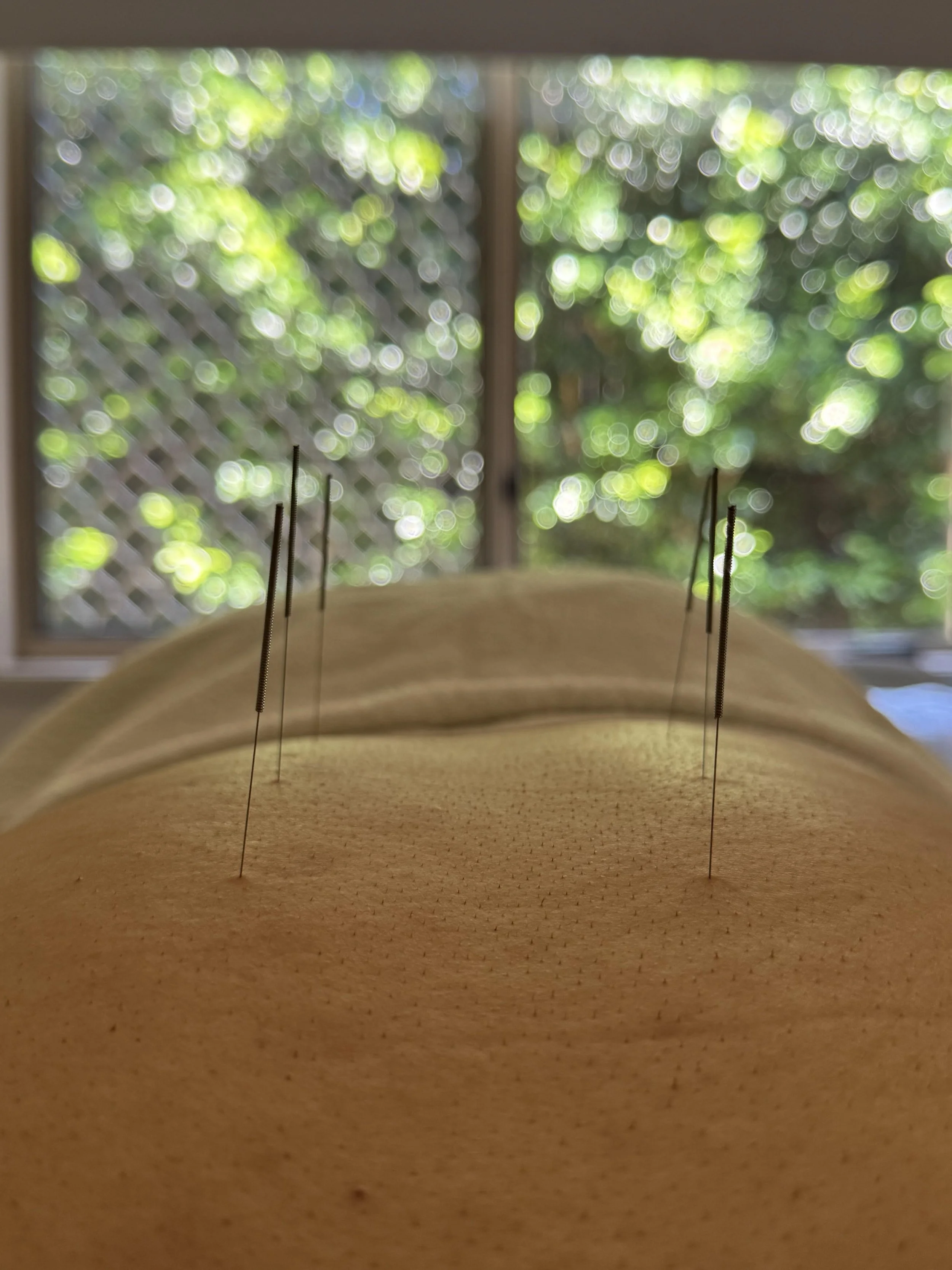 Acupuncture needles on a patient’s back performed by The Gentle Needle Guy, with natural greenery visible through the window at his Brisbane clinic.