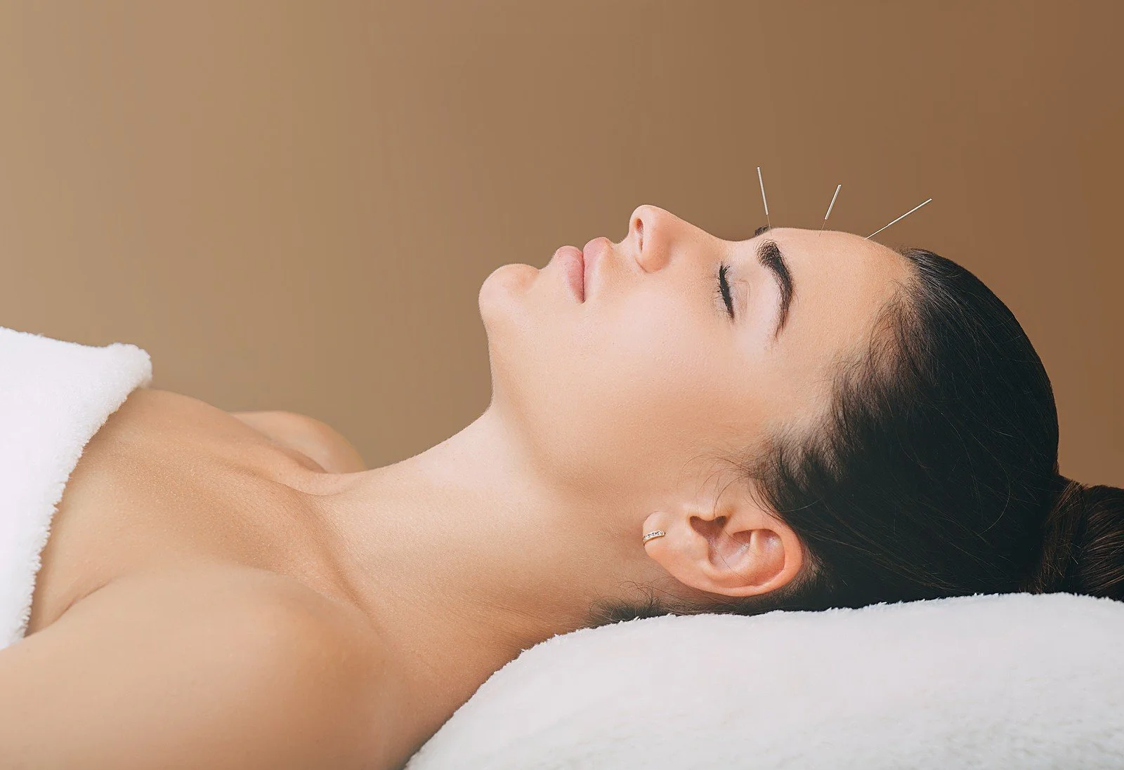 Acupuncture needles placed on the face to support relaxation and sleep.