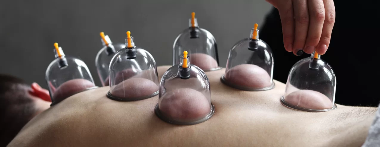 Traditional Chinese medicine cupping therapy applied across a patient’s upper back at a Brisbane acupuncture clinic.