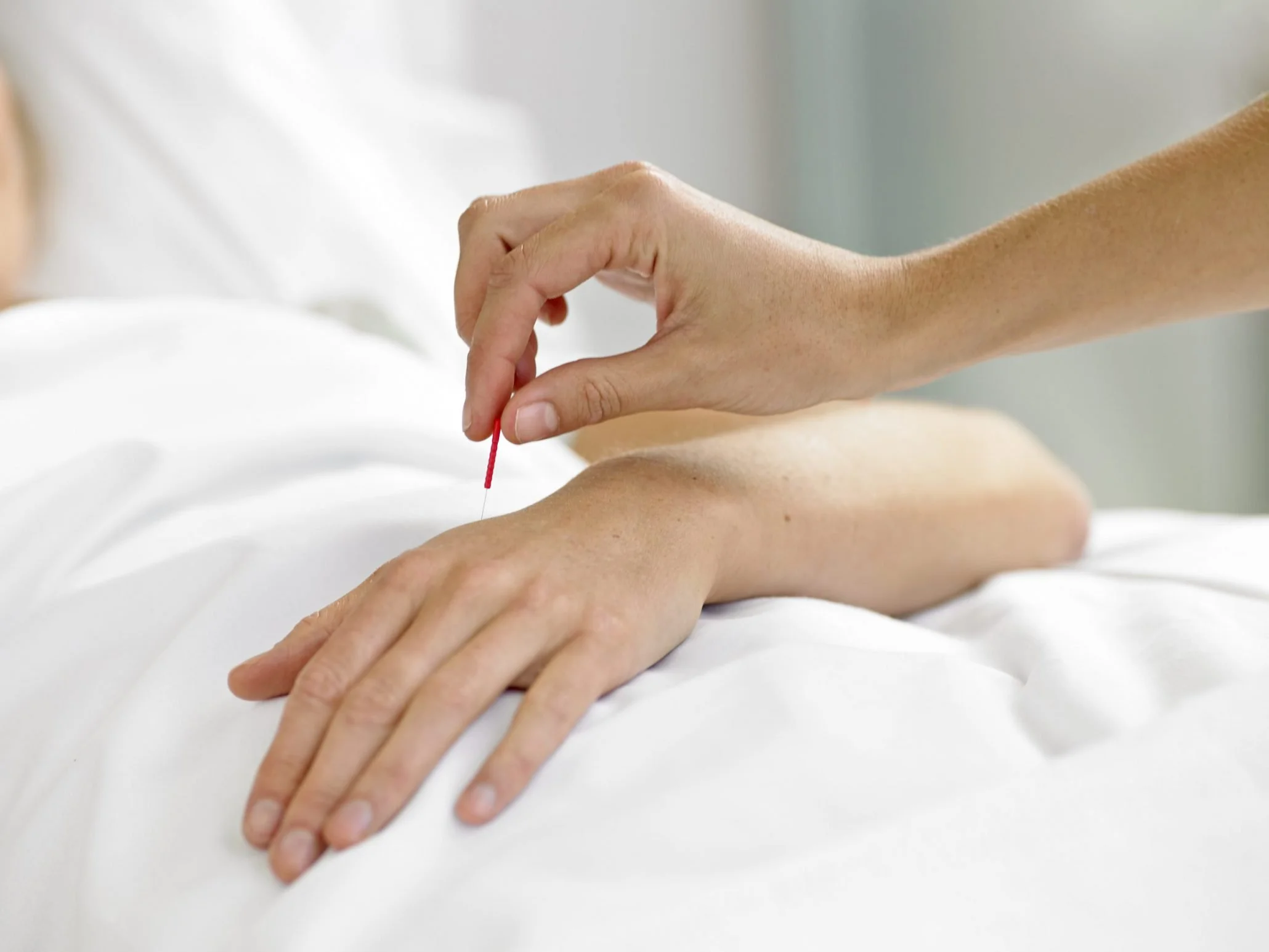 Acupuncture needle being applied to support stress and anxiety care in Brisbane