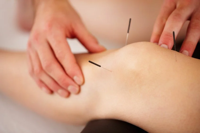 Acupuncture needles placed around the knee for joint pain and mobility support treatment
