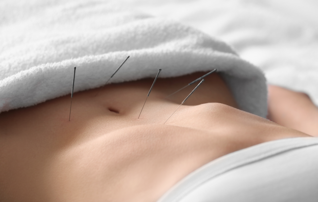 Acupuncture needles applied to abdomen for digestive health support in Brisbane