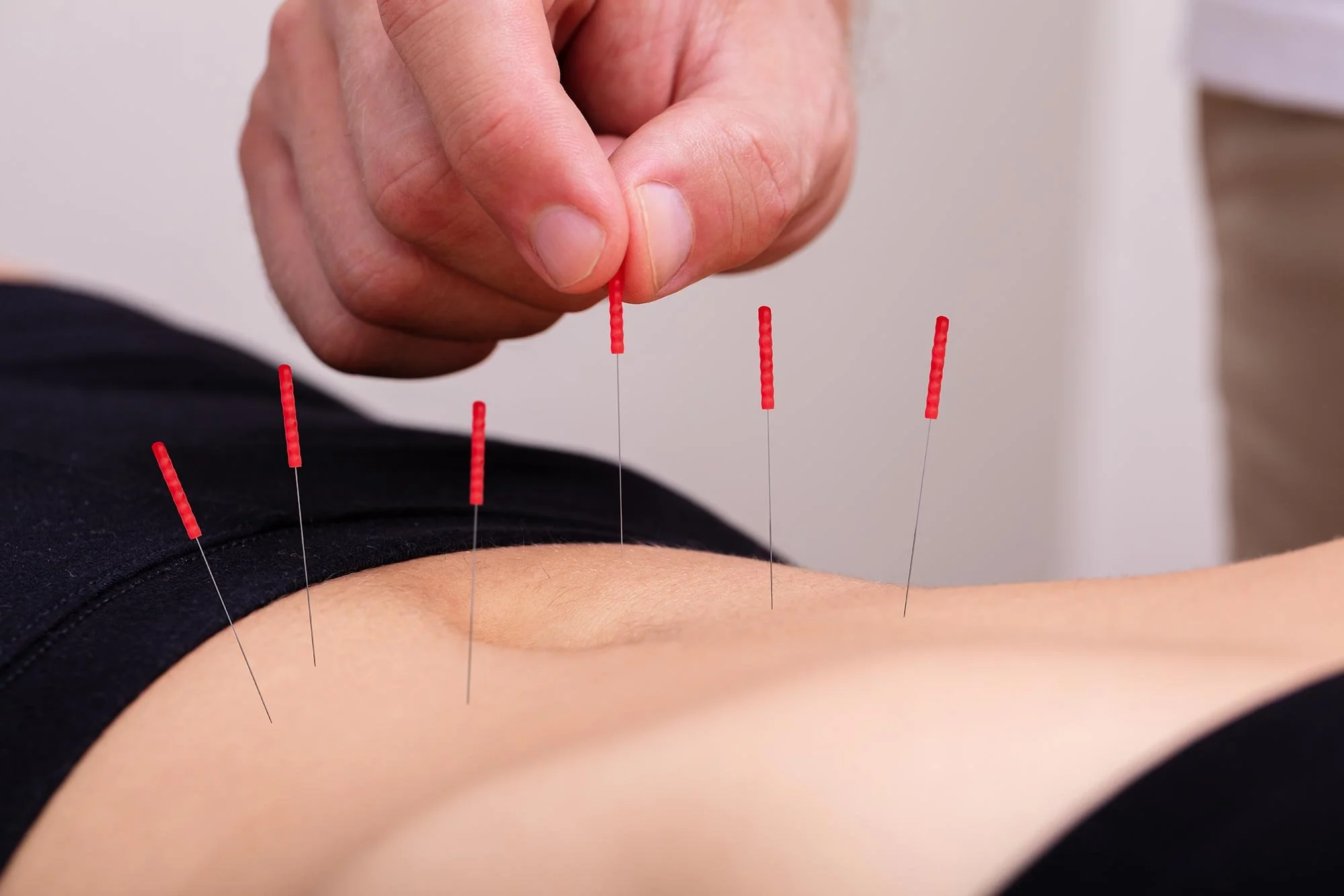 Abdominal acupuncture treatment used in Traditional Chinese Medicine to support digestion and weight loss.