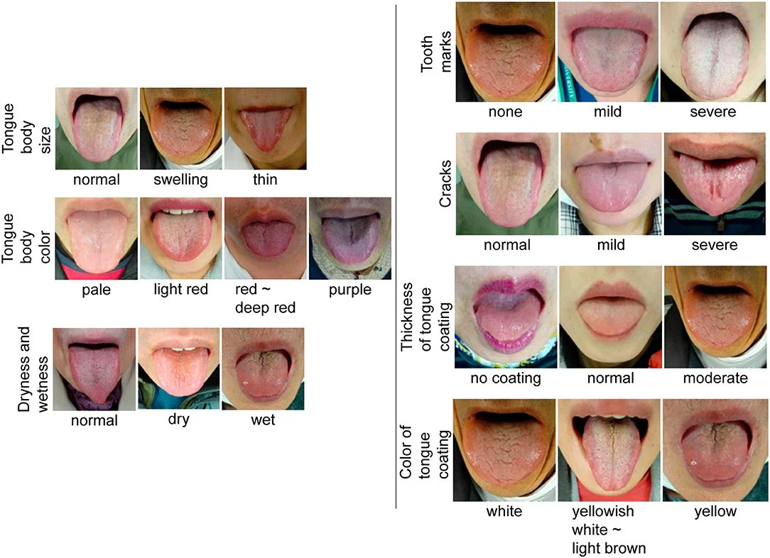 Various tongue characteristics, including body size (normal, swelling, thin), color (pale, light red, deep red, purple), dryness and wetness (normal, dry, wet), tooth marks (none, mild, severe), cracks (normal, mild, severe), thickness of coating (no coating, normal, moderate), and color of coating (white, yellowish, light brown).