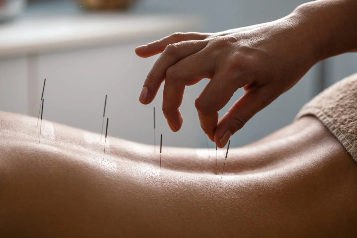 Practitioner placing acupuncture needles along the body to support circulation and muscle relaxation