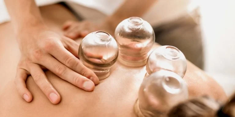 Cupping therapy on the upper back to release muscle tension at a Brisbane acupuncture clinic