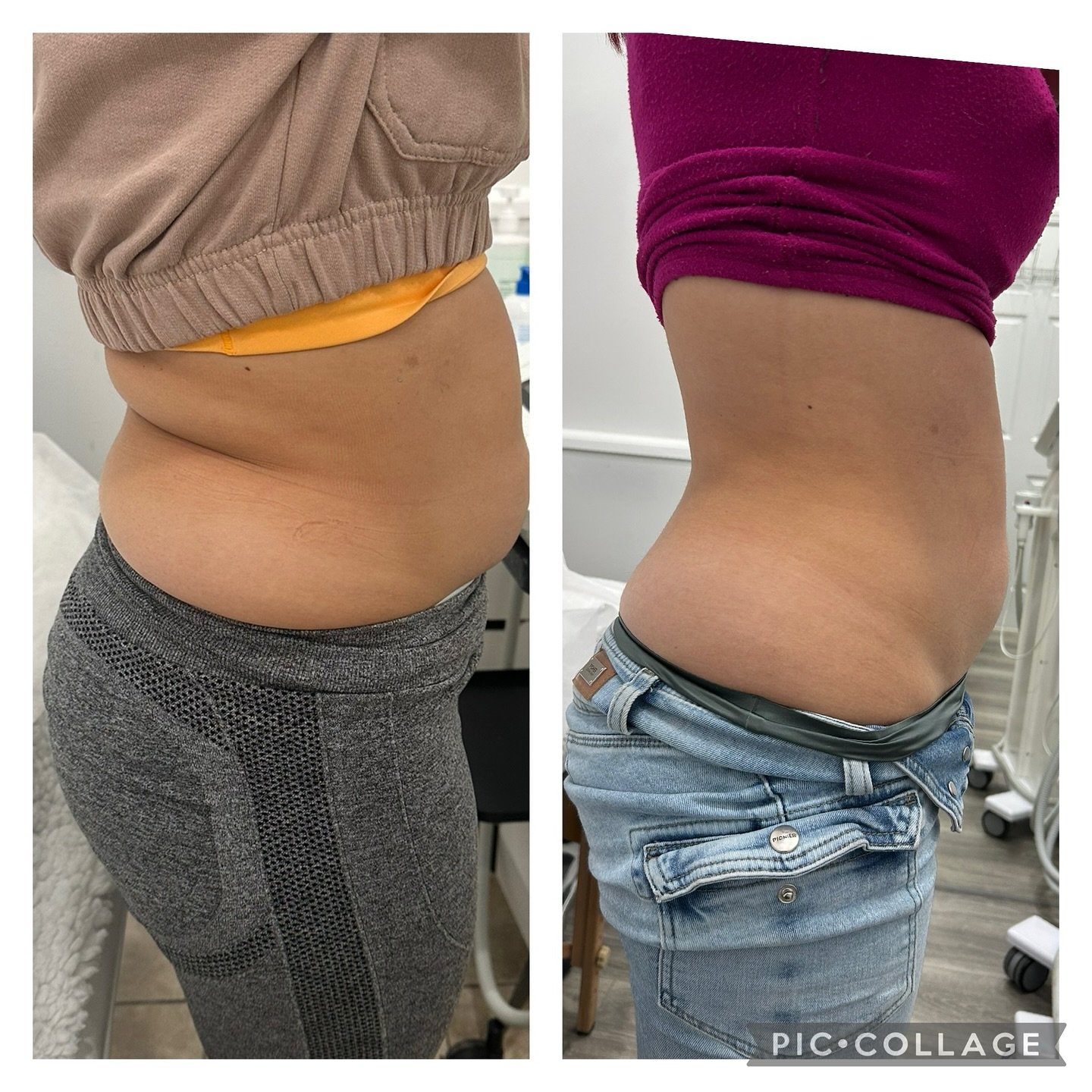 Freeze the fat away! โ๏ธ๐ฅ #CryoSlimming
#CryoSlimming #FatFreezing #CryoLipo #BodyContourin #CryoTherapy #NoSurgeryNeeded #SlimmingTreatmenr #CryoResults #FreezeTheFat #BodyGoals #NonInvasive #bodybeautySCULPT #SkinnyInTheCold #GlowUpWithCryo #cryot