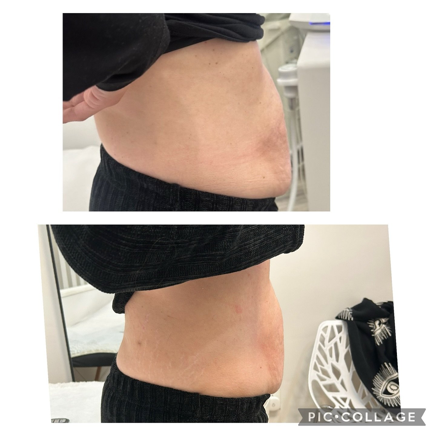 Cold never looked so Hot ๐ฅ
#cryotherapy #cryo #wellness #cryoskin #recovery #health #cryofacial #fitness #bodysculpting #infraredsauna #weightloss #cryolipolysis #skincare #cryotherapybenefits #coldtherapy #beauty #cryoslimming #bodycontouring #hea
