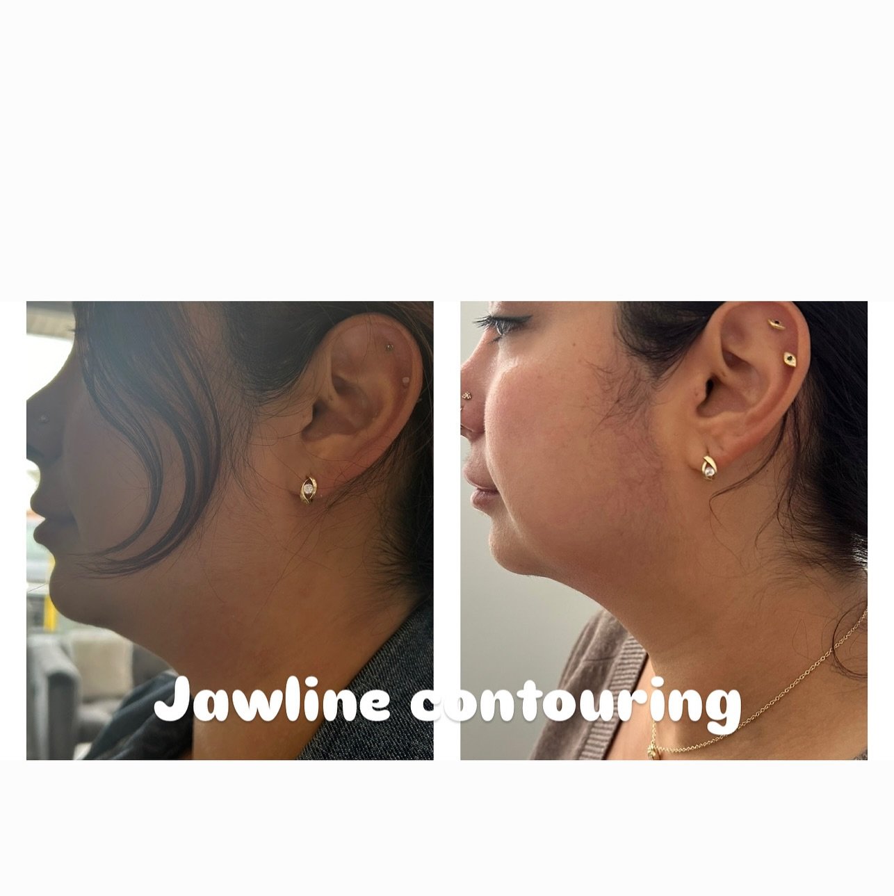Sculpted Jawline? Chill, we got this.
#cryotherapy #cryo #wellness #cryoskin #recovery #health #cryofacial #fitness #bodysculpting #infraredsauna #weightloss #cryolipolysis #skincare #cryotherapybenefits #coldtherapy #beauty #cryoslimming #bodycont