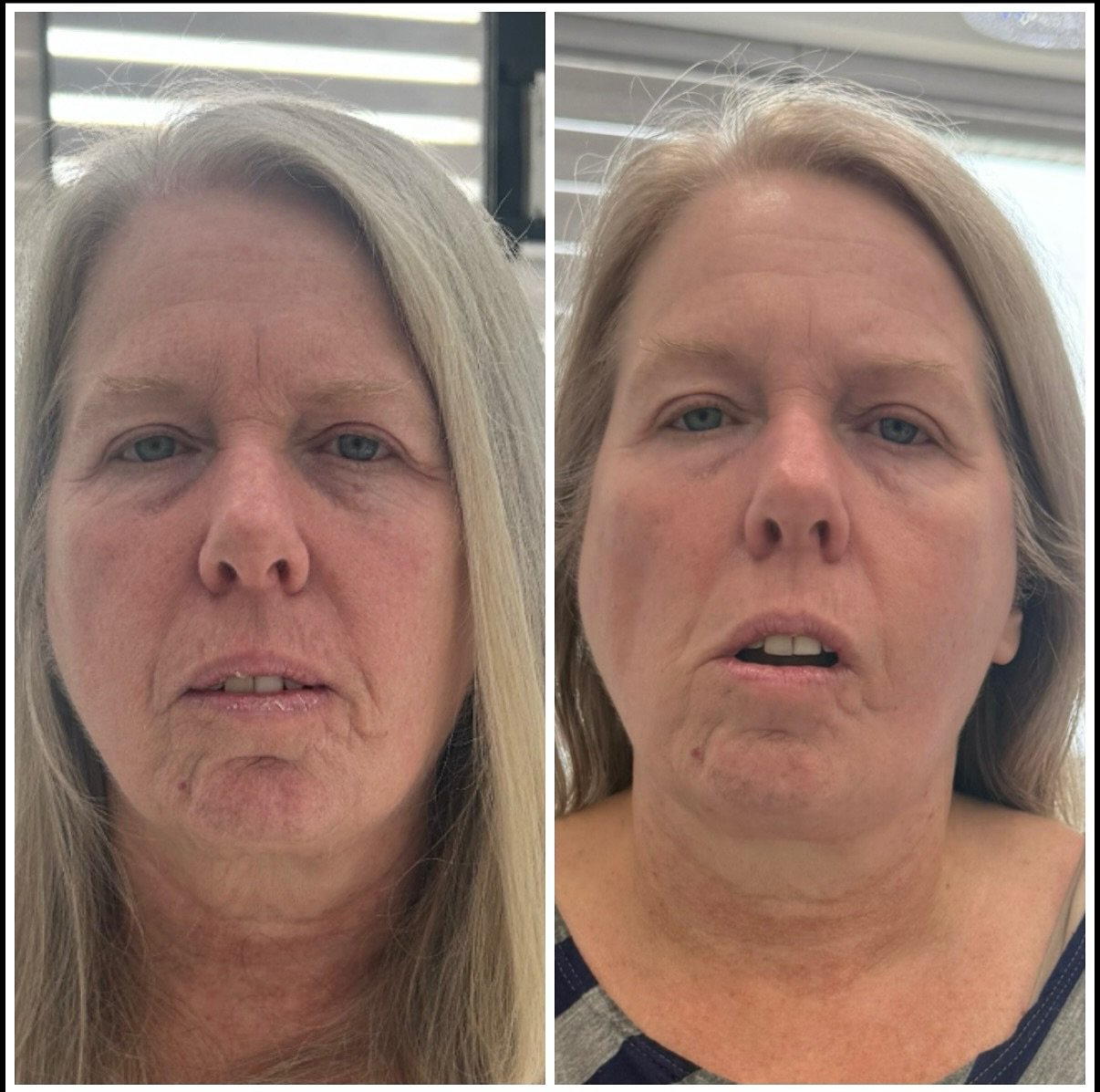 CRYOFACIALS โ๏ธ
โ
**Anti-Aging & Skin Tightening** – Boosts collagen, reduces wrinkles, and firms skin.
โ
**Reduces Puffiness & Breakouts** – Calms inflammation, shrinks pores, and helps with acne.
โ
**Instant Glow & Brighte