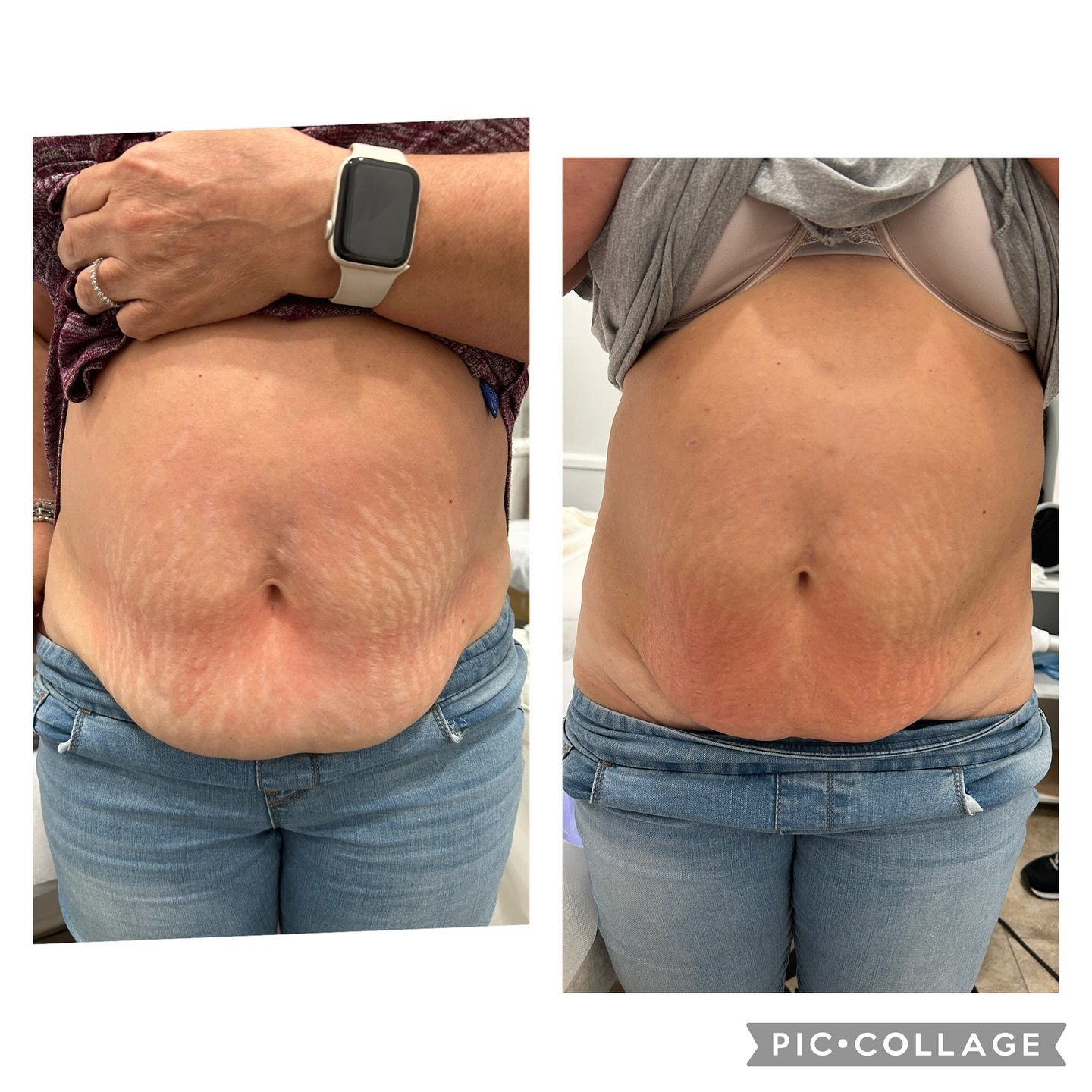 Bye bye fat & Say hello to a confident you !
#cryotherapy #cryo #wellness #cryoskin #recovery #health #cryofacial #fitness #bodysculpting #infraredsauna #weightloss #cryolipolysis #skincare #cryotherapybenefits #coldtherapy #beauty #cryoslimming