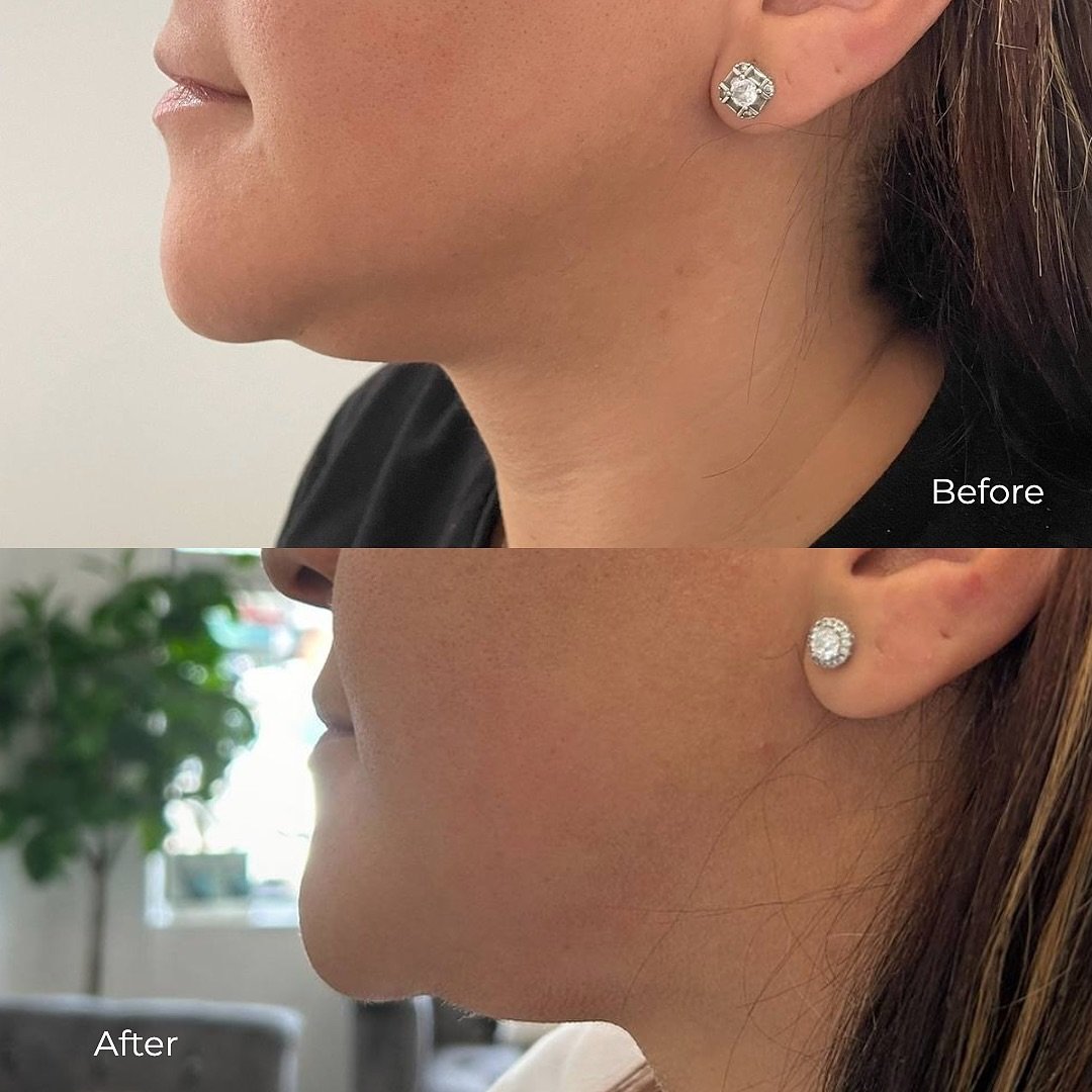 Double chin slimming
โ
Slimming for a double chin helps address the issues of ageing and sagging skin in a painless, non-invasive way. It is an excellent choice for anyone who wants to get rid of chin fat without undergoing surgery.
โ
Within a few we