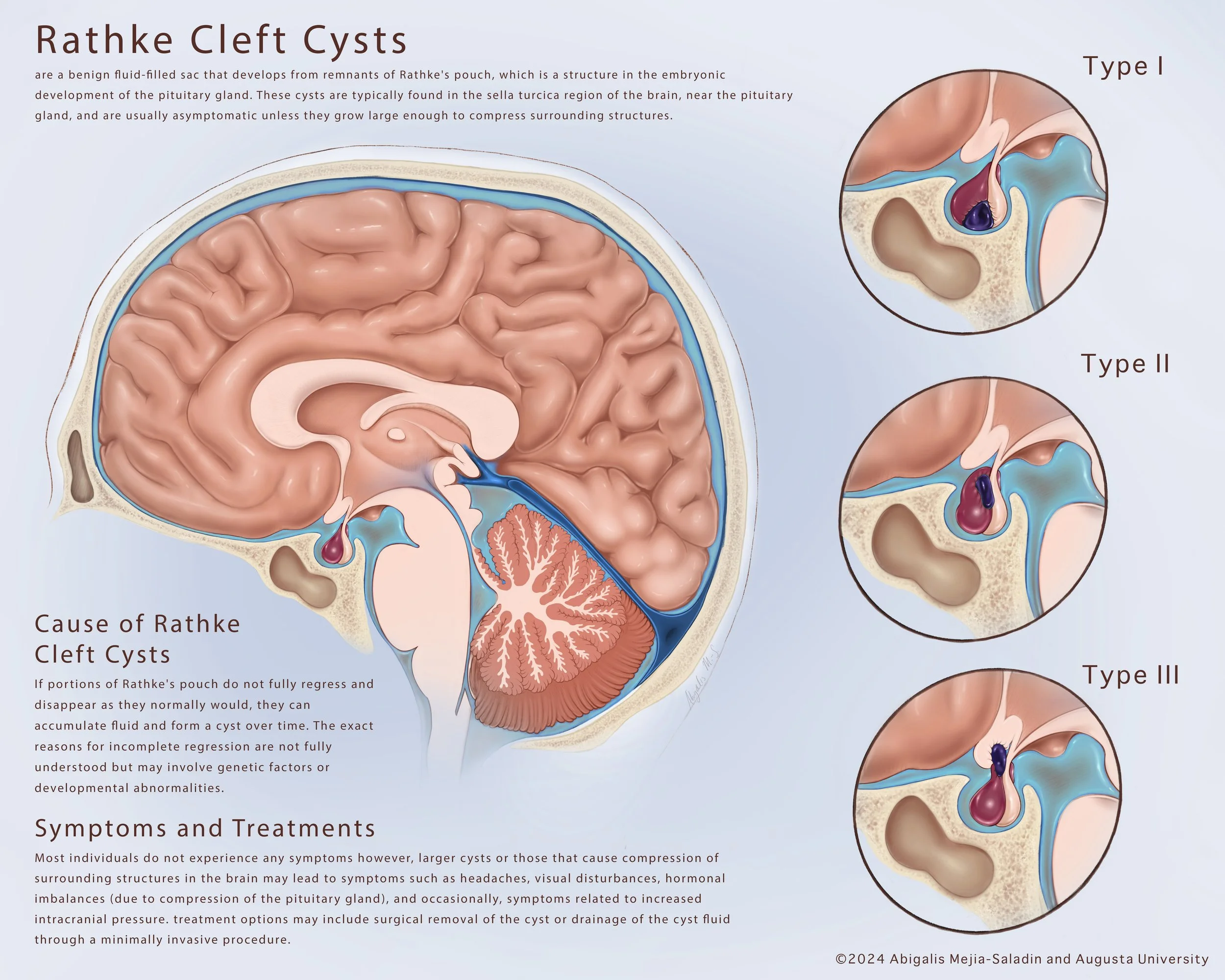 This is a neuro poster designed to show the gross pathologies of Rathke cleft cysts. This was sketched, scanned, and painted with Procreate and Adobe Photoshop.