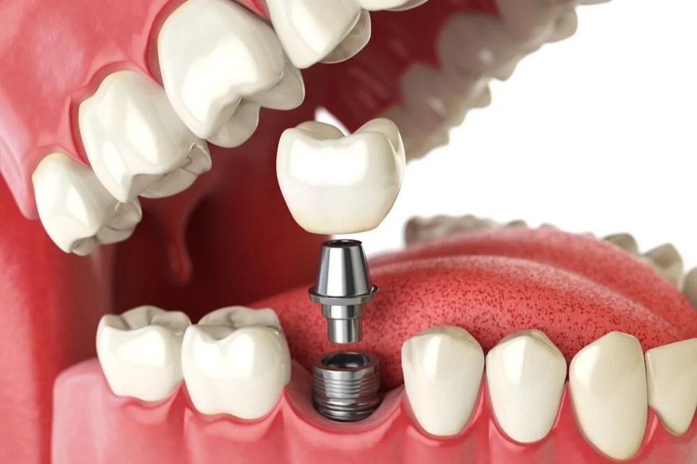 Dental-Implants-with-a-Crown.jpg