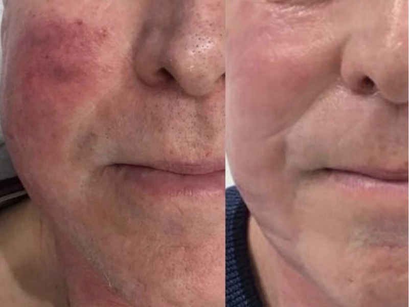 9.0-dye-vl-treatment-before-after.png