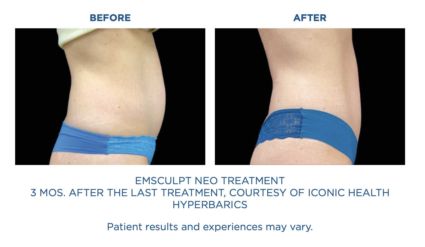 Emsculpt4.png