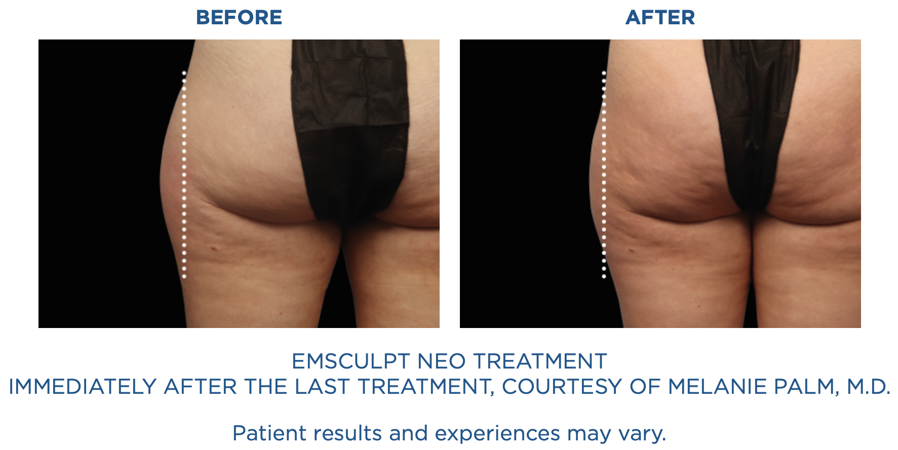Emsculpt.png