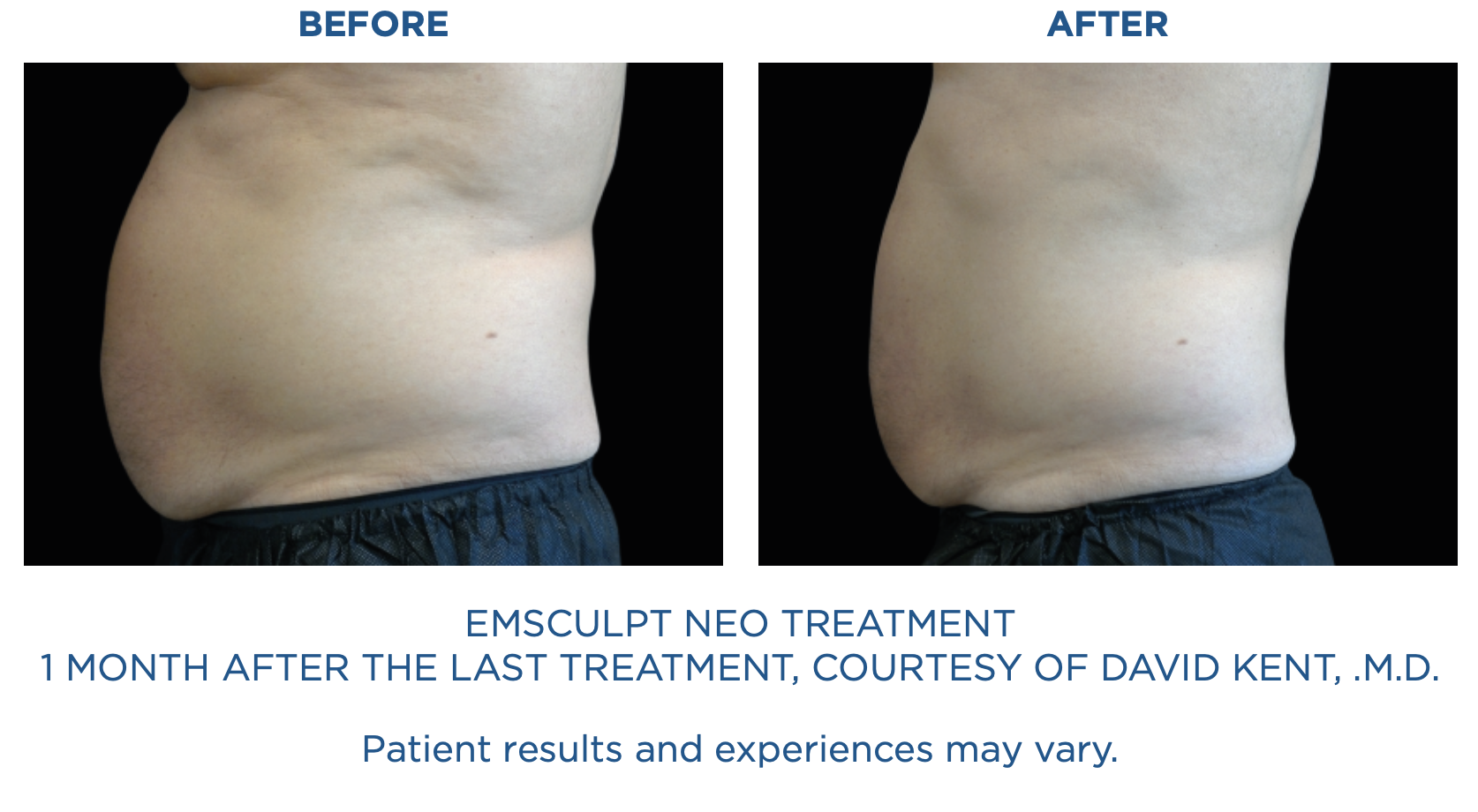 Emsculpt3.png