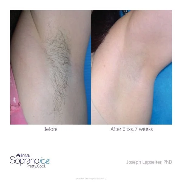 Soprano-ICE-Before-and-After-B2C-7-Hair-Removalweb.jpg