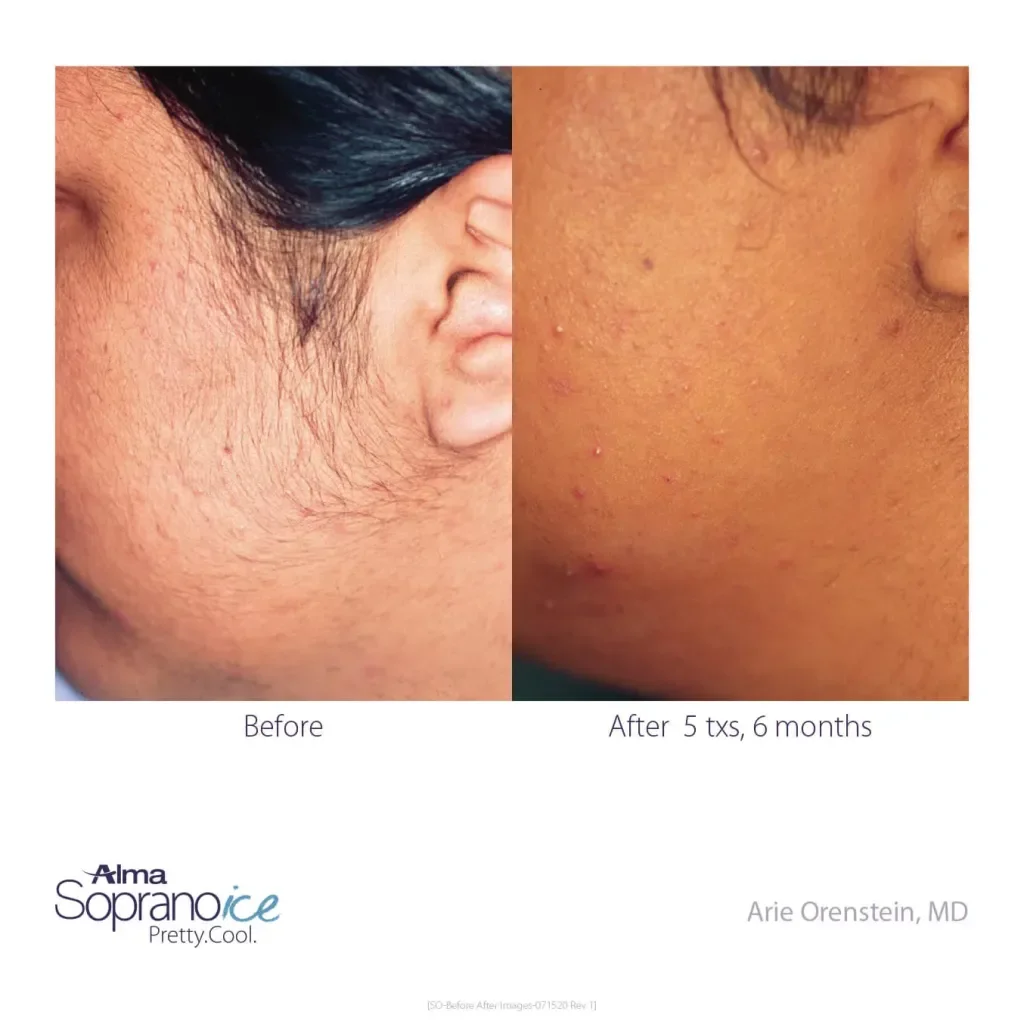 Soprano-ICE-Before-and-After-B2C-3-Hair-Removal.jpg.webp