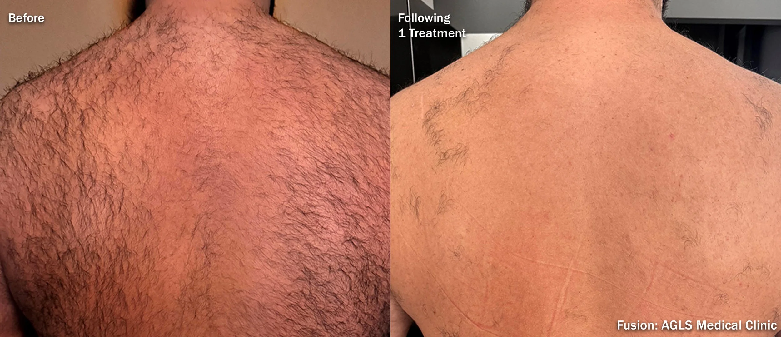 Comparison of a man's back before and after a laser hair removal treatment. The 'before' side shows a back with dense hair and redness, while the 'after' side shows a smoother back with significantly less hair and improved skin condition.