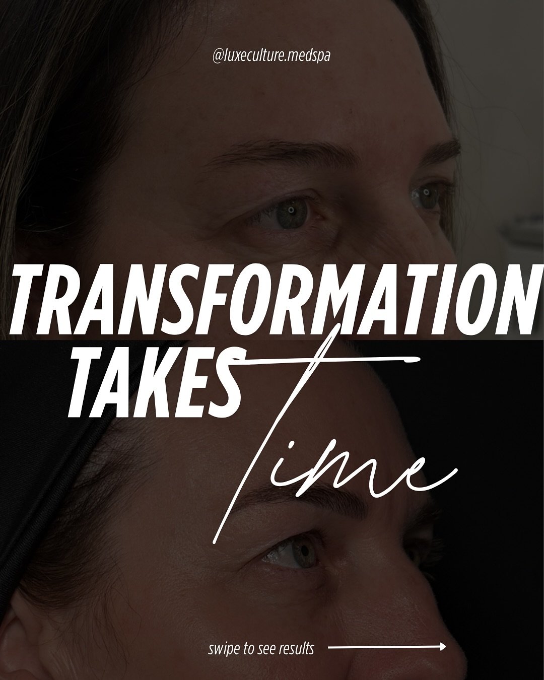 ✨ A Year of Subtle, Sustainable Glow ✨
This transformation didn&rsquo;t happen overnight &mdash; and that&rsquo;s exactly the point.

Over the last year, this beautiful patient trusted the process with a customized plan including:
🧴 Medical-grade sk