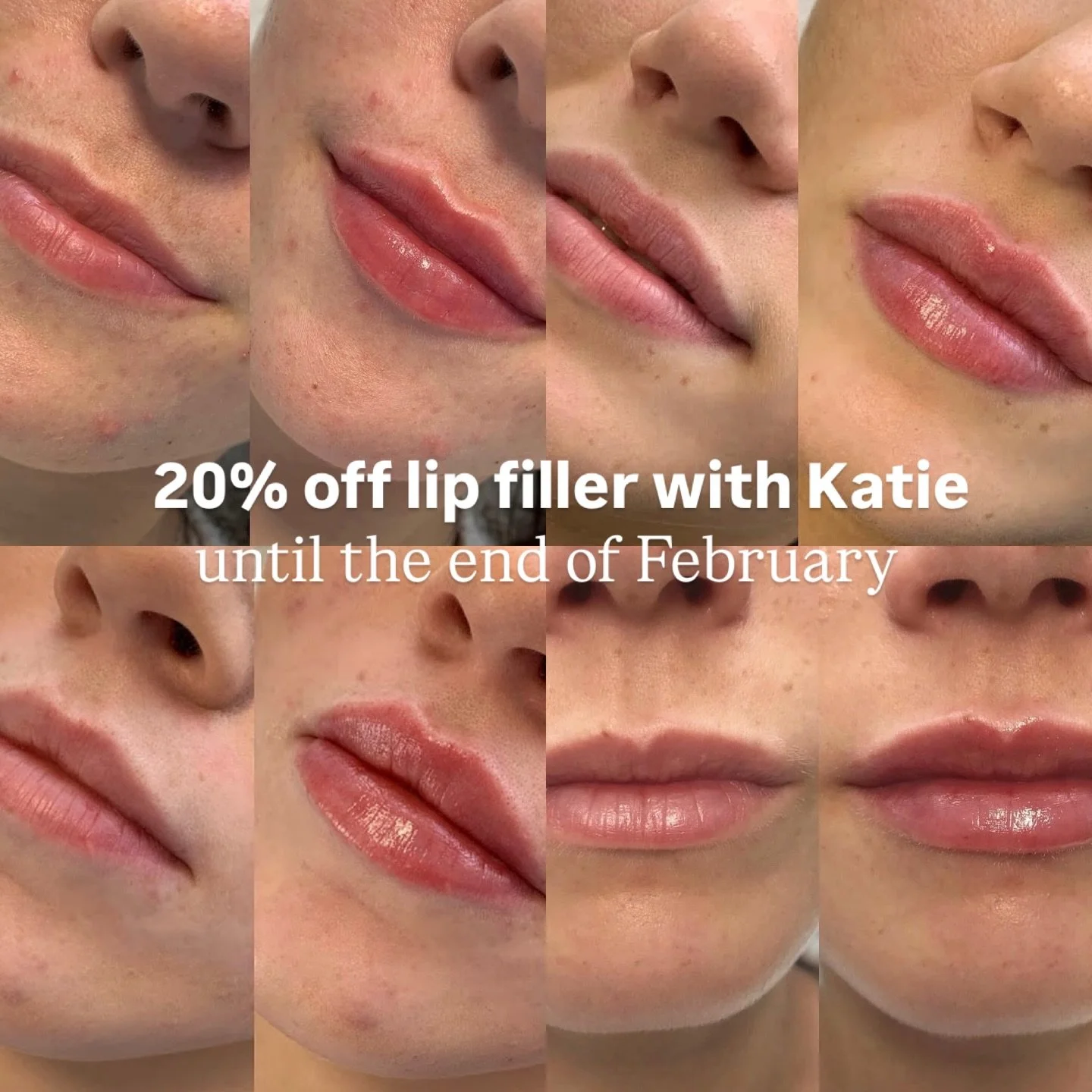 To celebrate Valentine's weekend there's 20% off lip filler with Katie until the end of February 💋

How beautiful are all of these lip filler results by our Nurse Katie, balanced, hydrated and natural. 

We've released appointments on the 18th and 2
