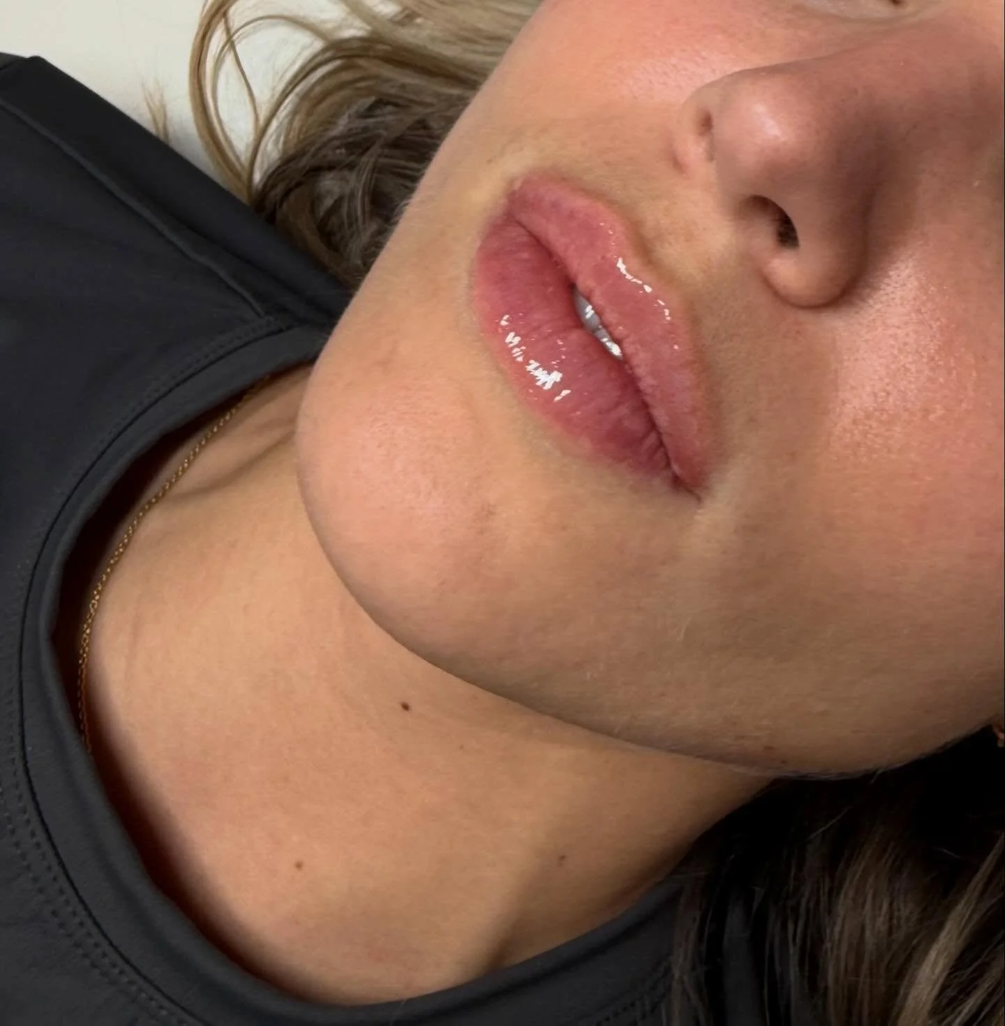 I often hear from patients that their hesitation isn&rsquo;t about the treatment itself, but about how it will look afterwards. Many have seen results that feel heavy or out of balance with the natural features of the face, and then worry about losin