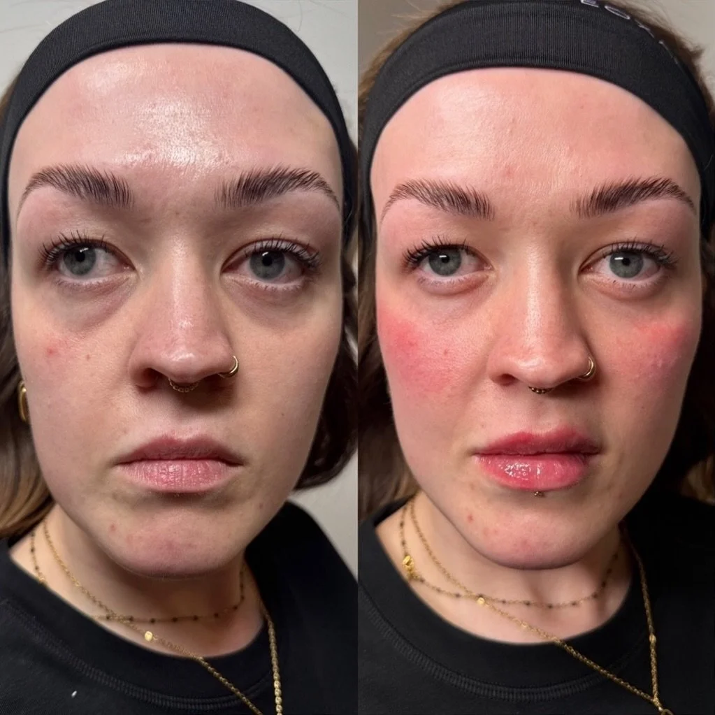 Natural filler results, real confidence ✨

This treatment focused on the midface, deep pyriform space and lips to restore balance and enhance natural features. 

By adding gentle support through the midface and pyriform, we create a lifted, refreshed