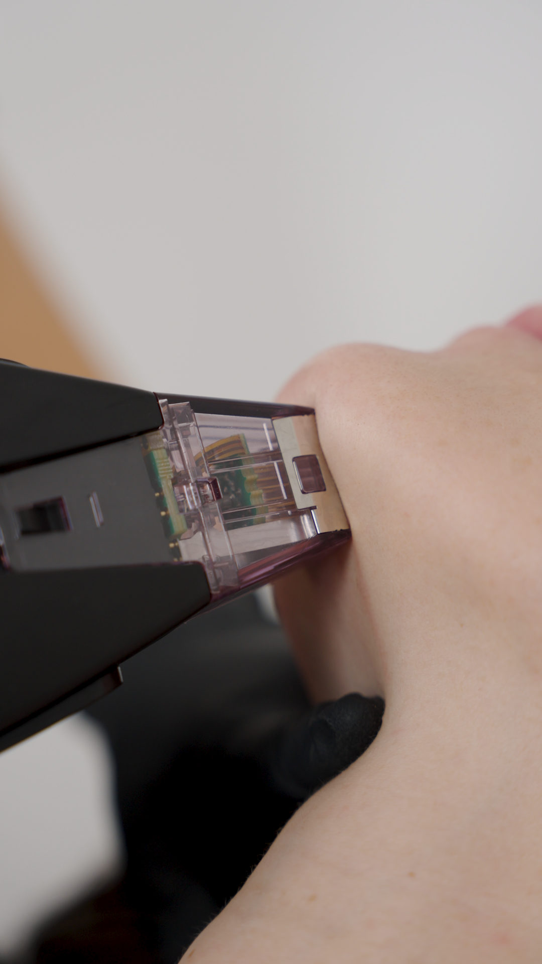 treatment for acne scaring derby