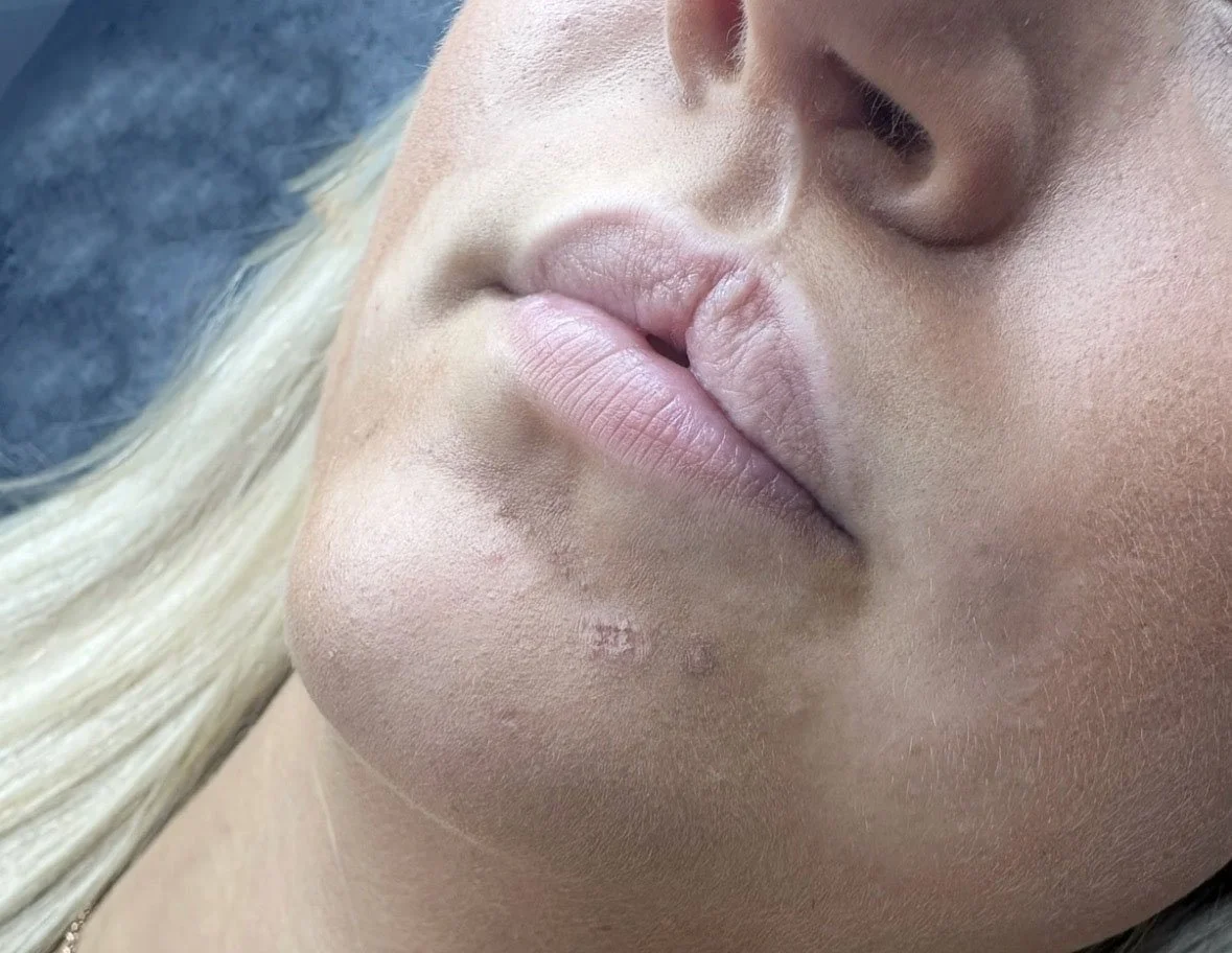 lip filler derby - applied as a reconstructive treatment for a cleft lip