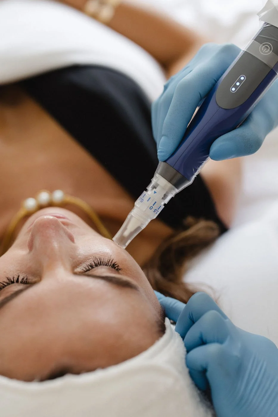 Skinpen microneedling device being used in a derby aesthetics clinic