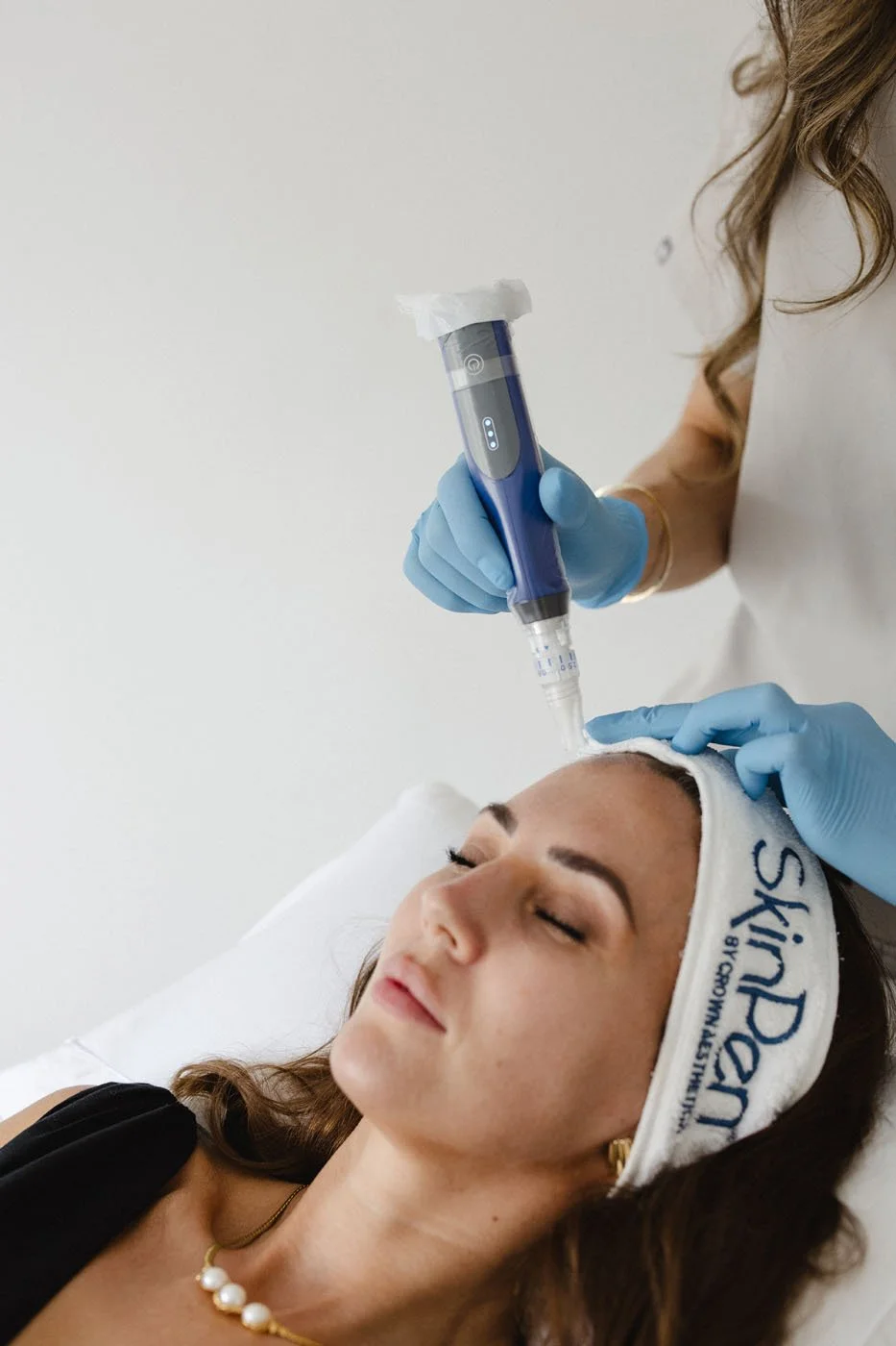 skinpen microneedling Derbyshire