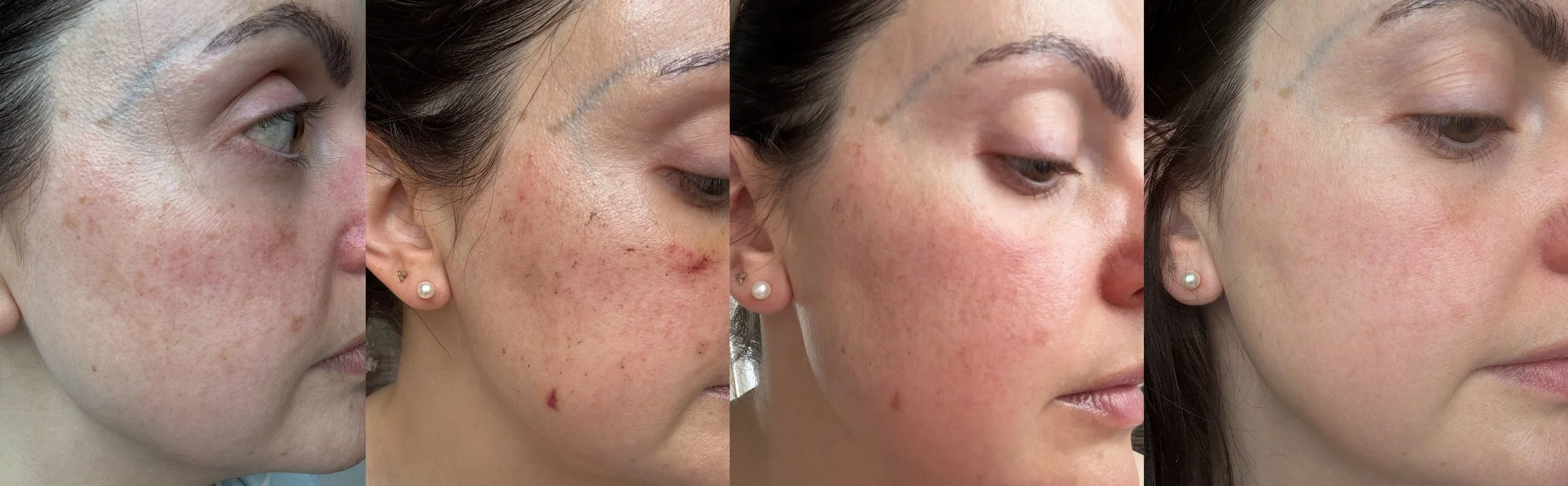 Lumecca peak healing process derby clinic