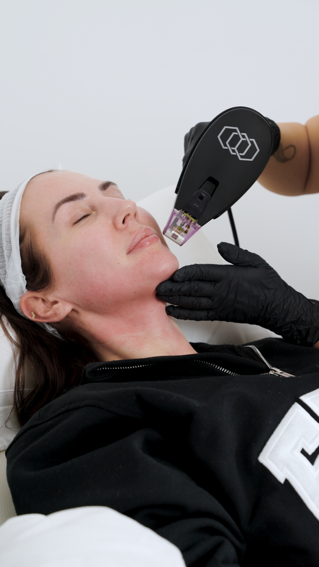 non surgical facelift derby