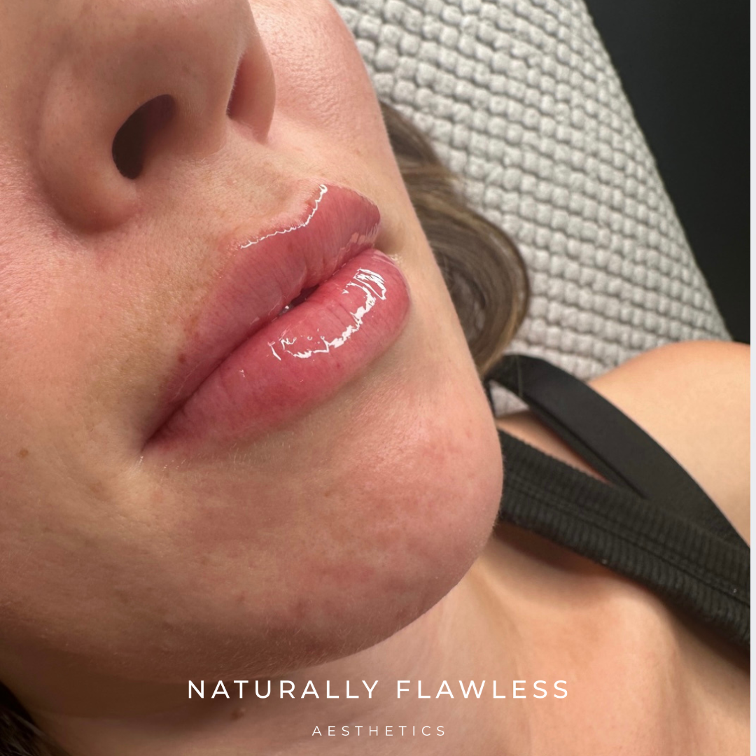 natural lip filler clinic in derby. Nurse led.