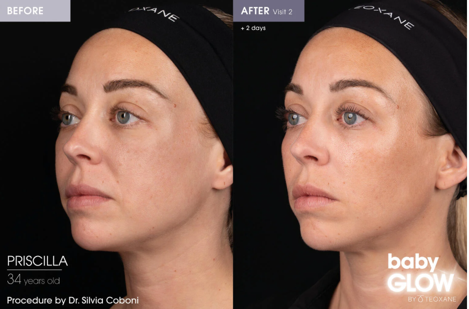 Teoxane Baby Glow treatment Before and After. treatment available in Derbyshire