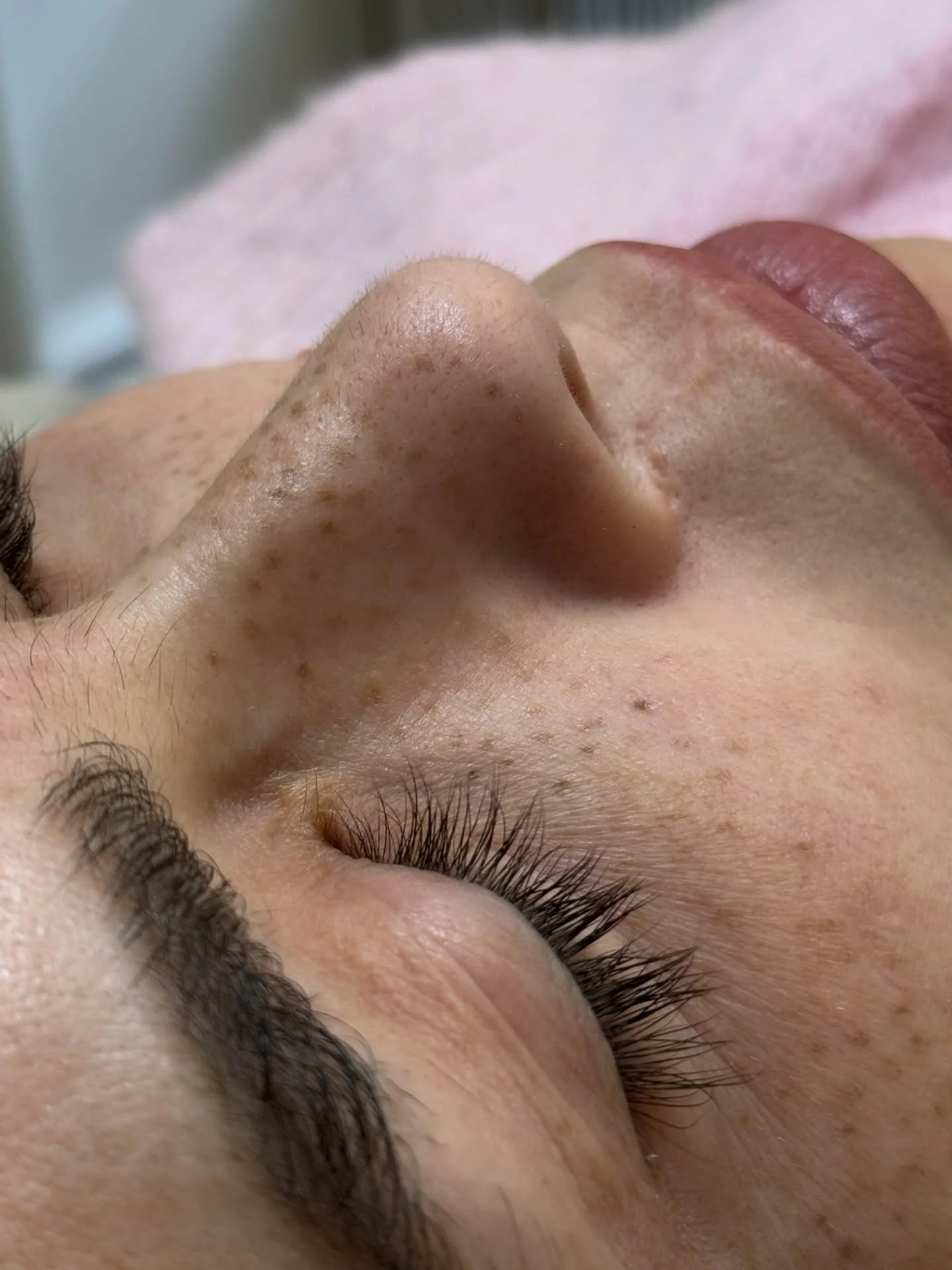 abgeheilte Fake Freckles.

Besonders im Herbst/ Winter k&ouml;nnen t&auml;towierte Sommersprossen dir die Frische wieder geben, die du noch im Sommer hattest. 

Haltbarkeit: 6 - 24 Monate 

#fakefreckles #t&auml;towiertesommerspossen #fauxfreckles