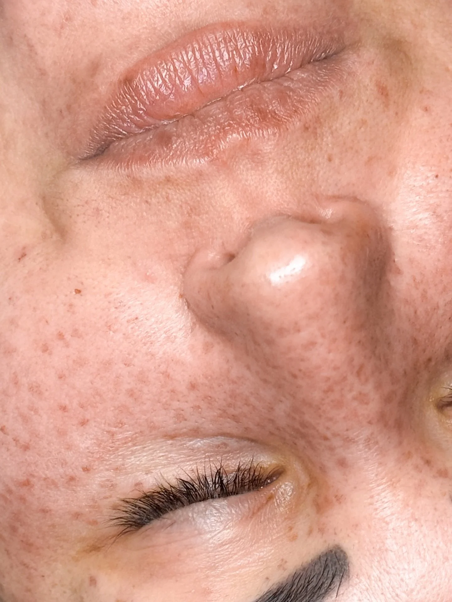 Fresh freckled Sommersprossen, die so nat&uuml;rlich pigmentiert sind, das selbst ein Hautarzt die nicht von echten Sommersprossen unterscheiden kann. 

Paket L
Haltbarkeit: 6-24 Monate

#fakefreckles #tattooedfreckles #cosmetictattooing #tattoosomme