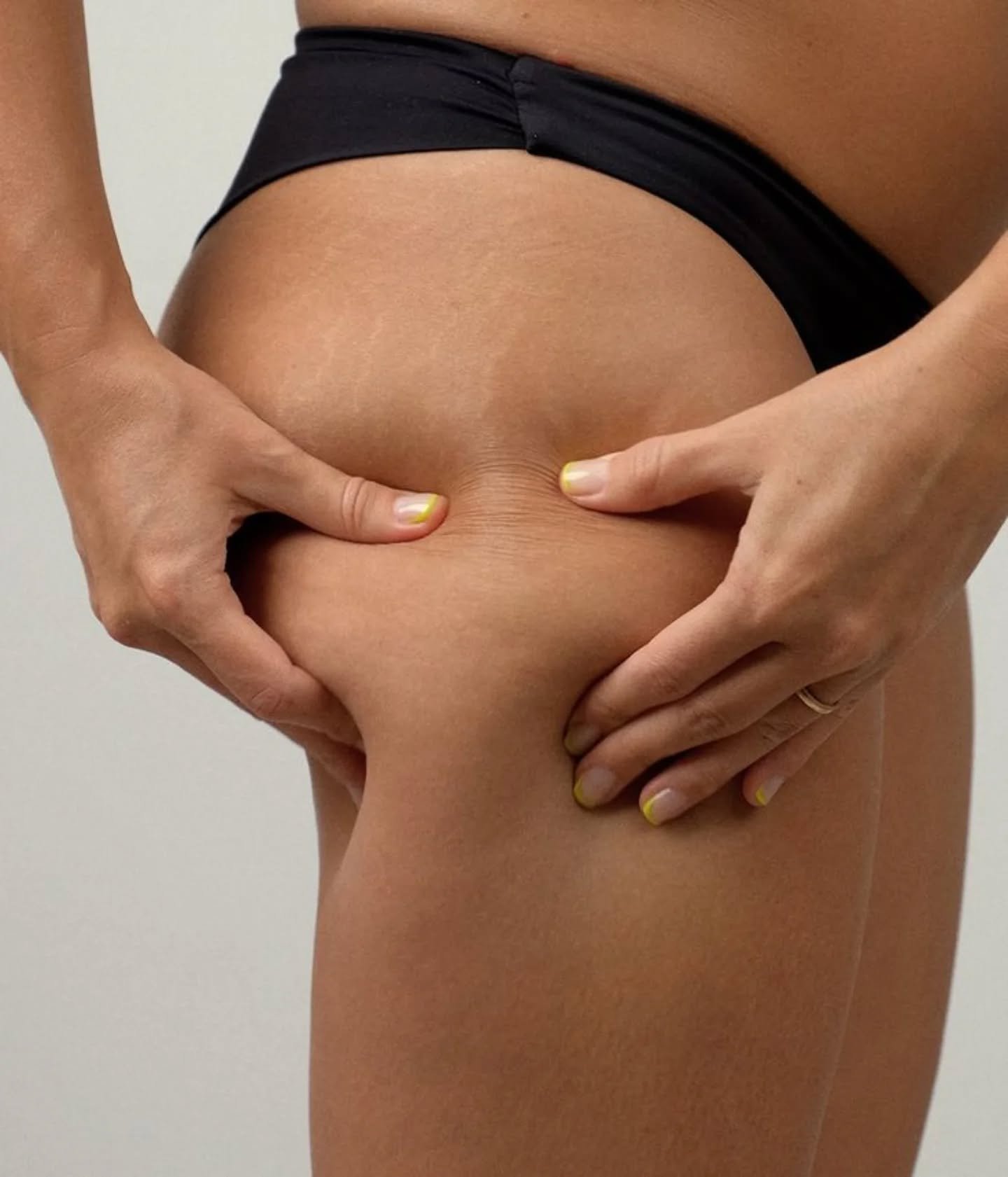 📢 Stop aux complexes : la cellulite, c&rsquo;est normal !
🚫 La cellulite n&rsquo;est pas une question de poids.
🚫 Ni un signe de manque de sport ou de soin.

C&rsquo;est un ph&eacute;nom&egrave;ne naturel du corps f&eacute;minin, li&eacute; aux ho
