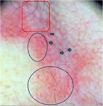Imagen de piel con áreas resaltadas en rectángulo y círculos, con flechas señalando esas zonas.