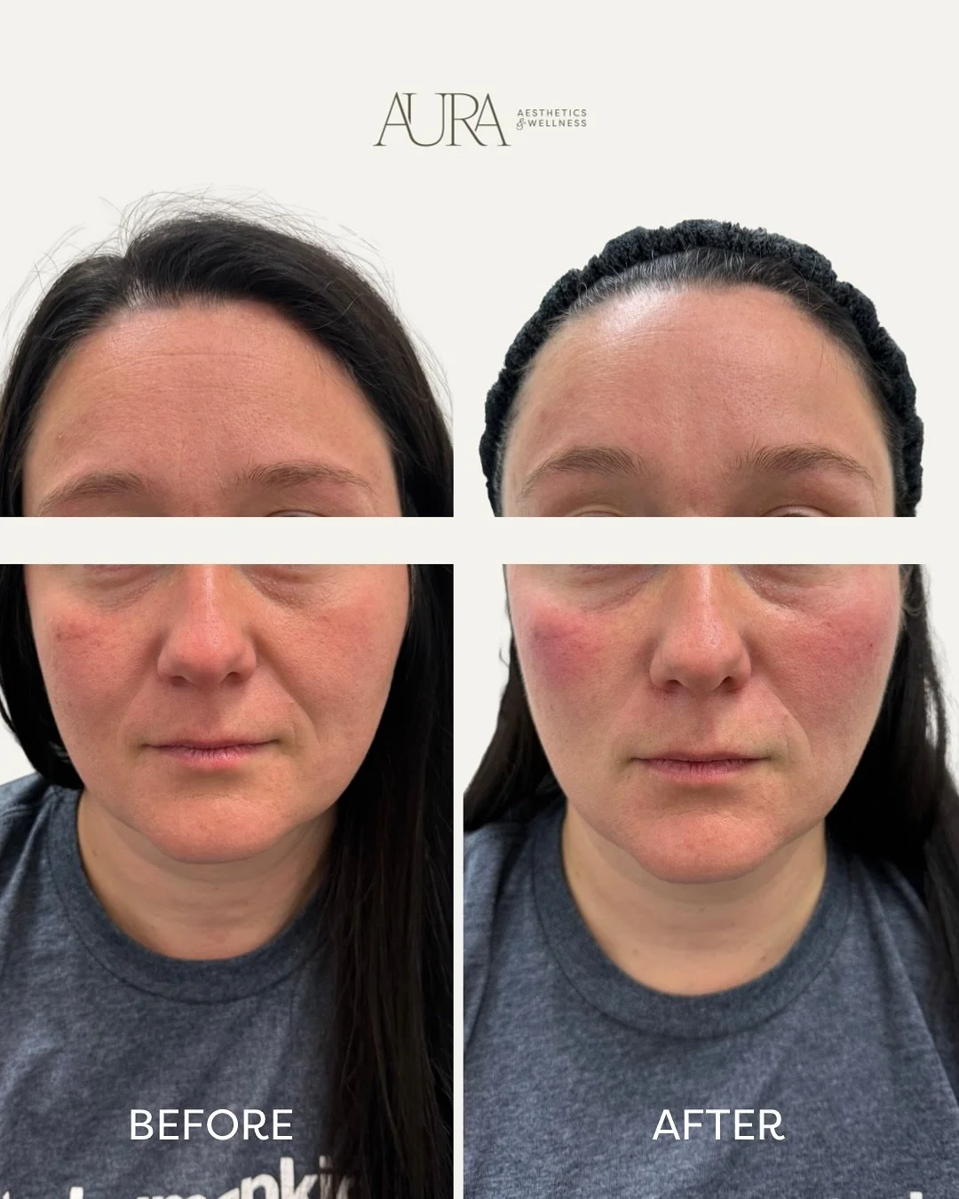 Filler done naturally and beautifully! 💕

We did a little lateral and medial cheek, helping this gal feel refreshed and like herself! Notice the softening of her nasolabial folds. 👏🏻 

💉Thinking about injectable treatments, but not sure where to 