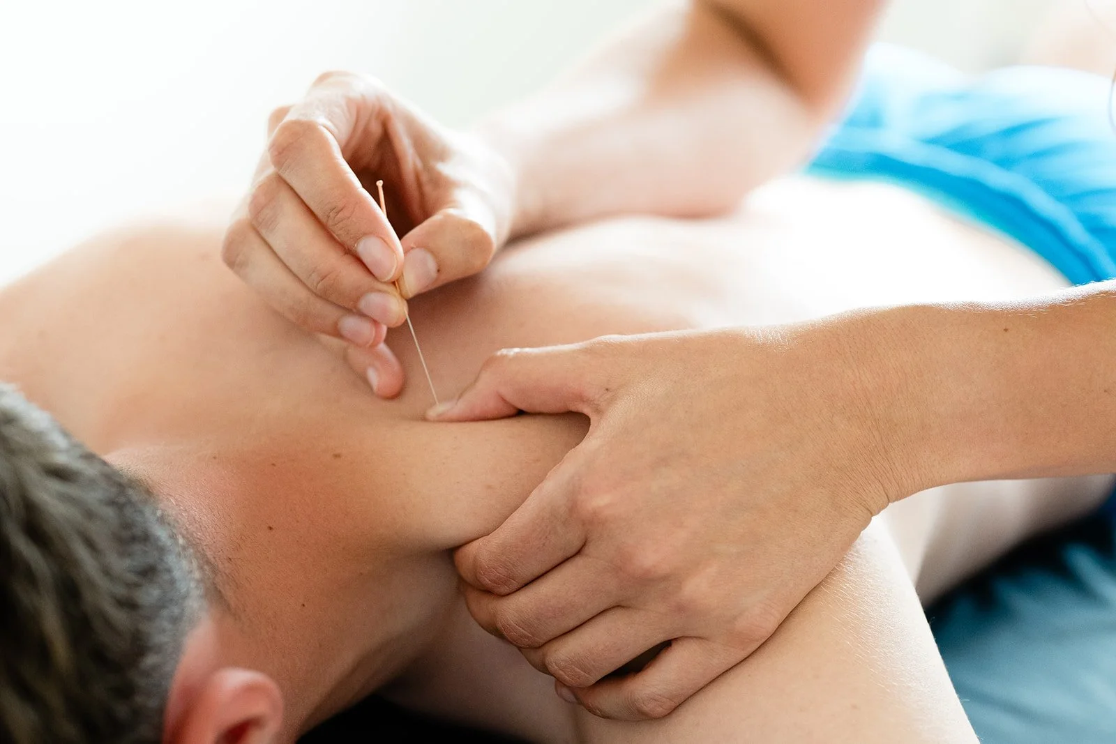 Triggerpoints, dry needling, pijnverlichting