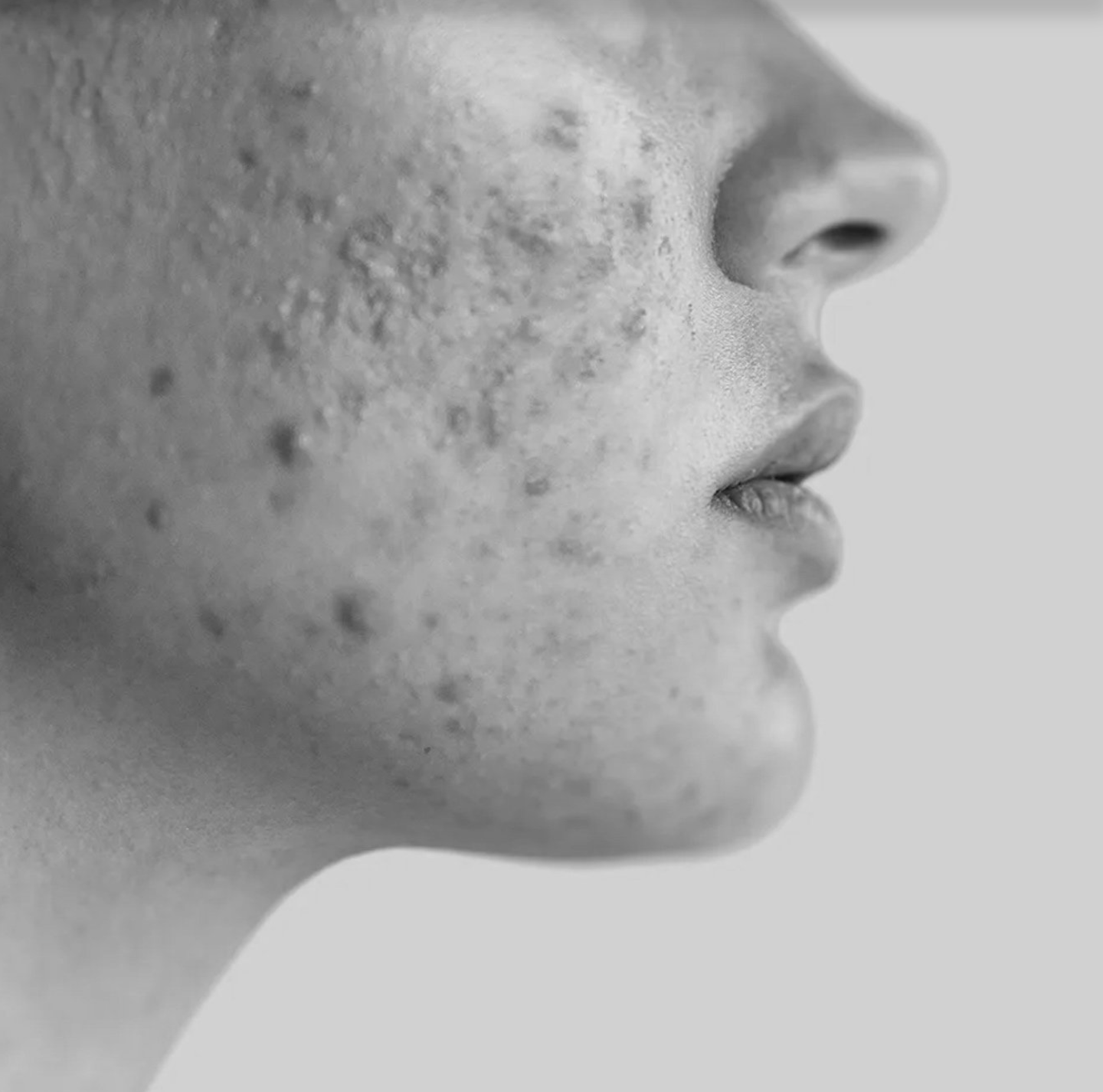 Close-up of a person's face in profile, showing part of the nose, lips, and cheek with textured skin.