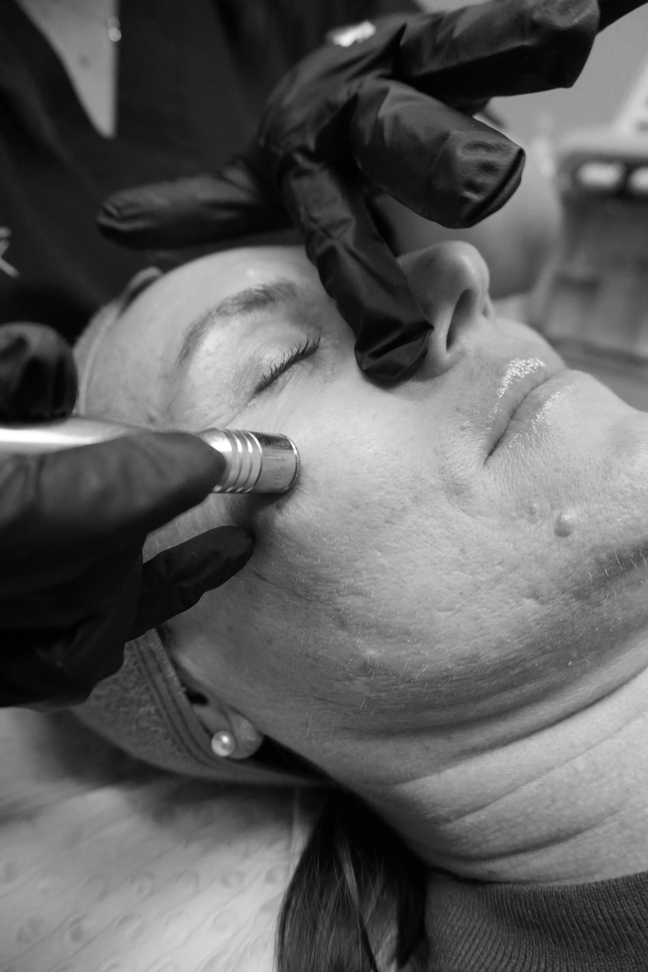 A person receives a cosmetic treatment on their face, lying on a treatment bed with eyes closed, while a practitioner in black gloves uses a pen-like device near the person's cheek.