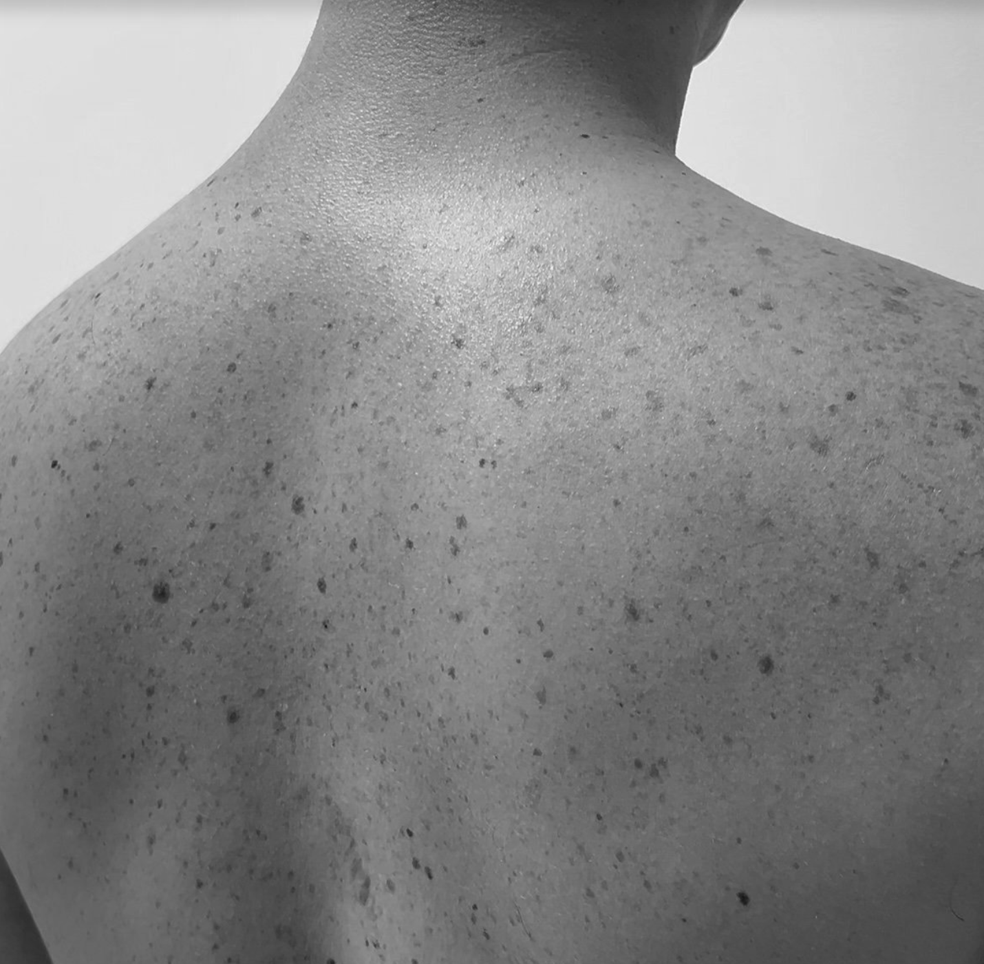 Close-up of a person's shoulder and upper back, showing acne scars and skin texture in black and white.