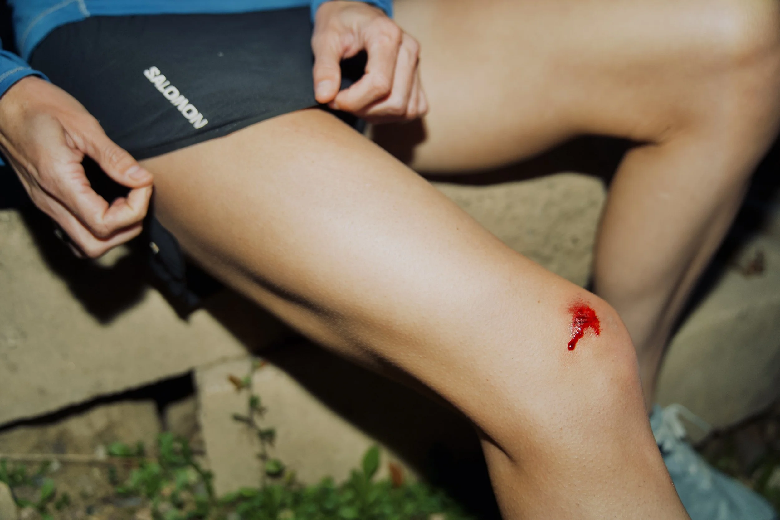 A person with a bleeding injury on their leg, sitting outside on the ground.