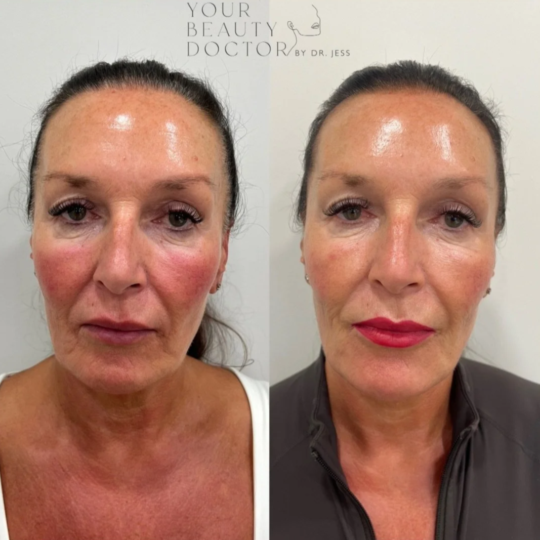 Sofwave non surgical facelift Nottingham