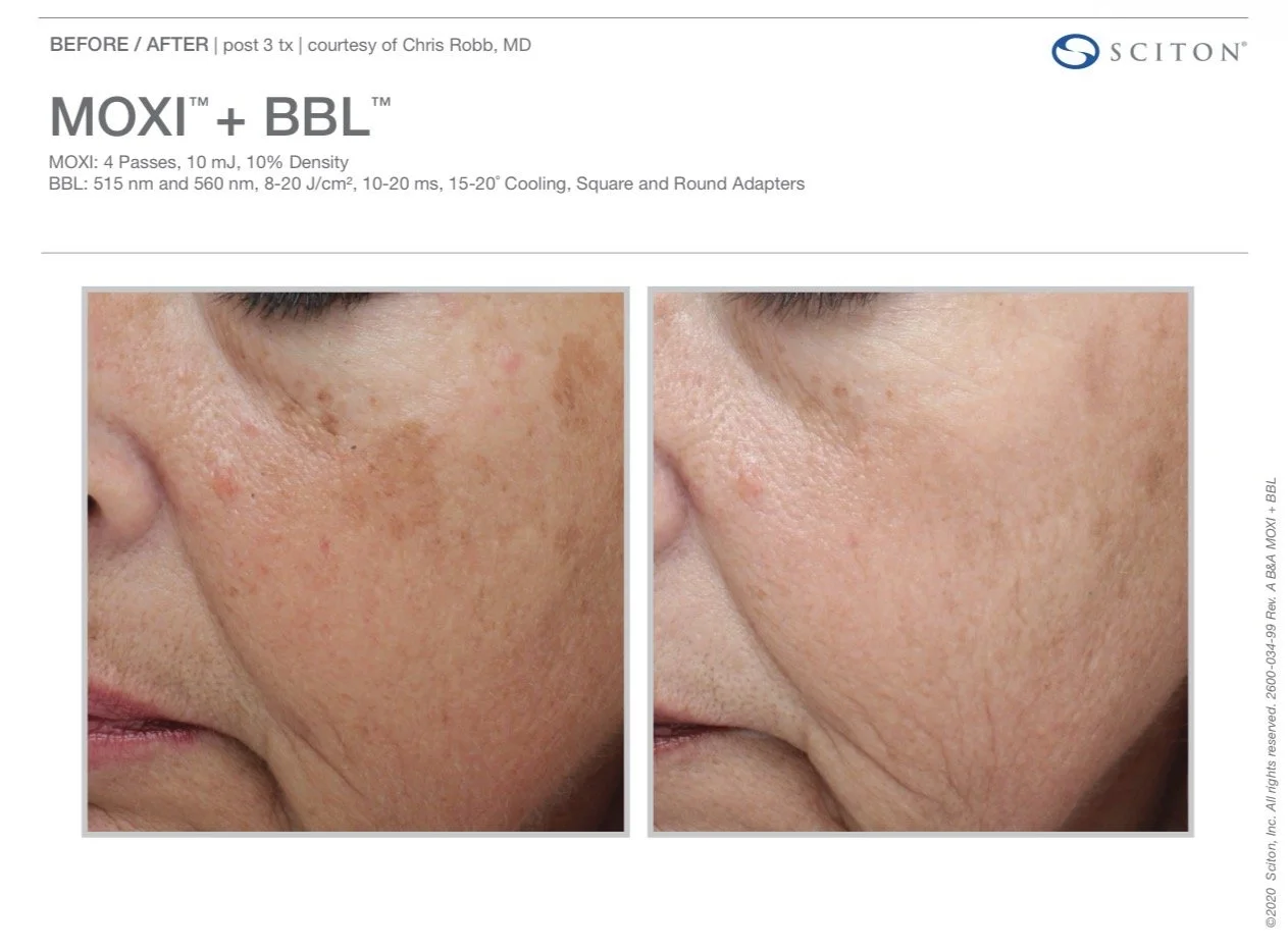 moxi laser skin treatment nottingham